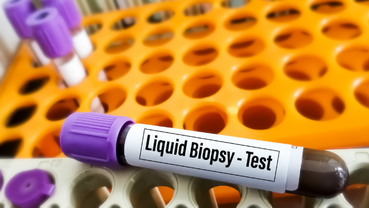 Liquid Biopsies: Revolutionizing Cancer Diagnosis and Monitoring