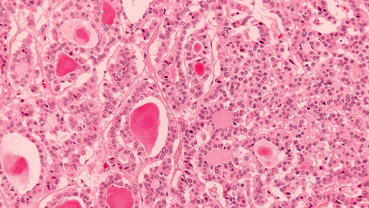 Call this "A Question of Answers - Neuroendocrine Tumours"