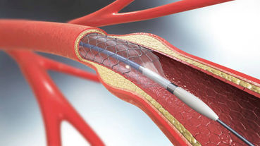 Enhancing Cardiac Health: Exploring the World of Cardiovascular Stents