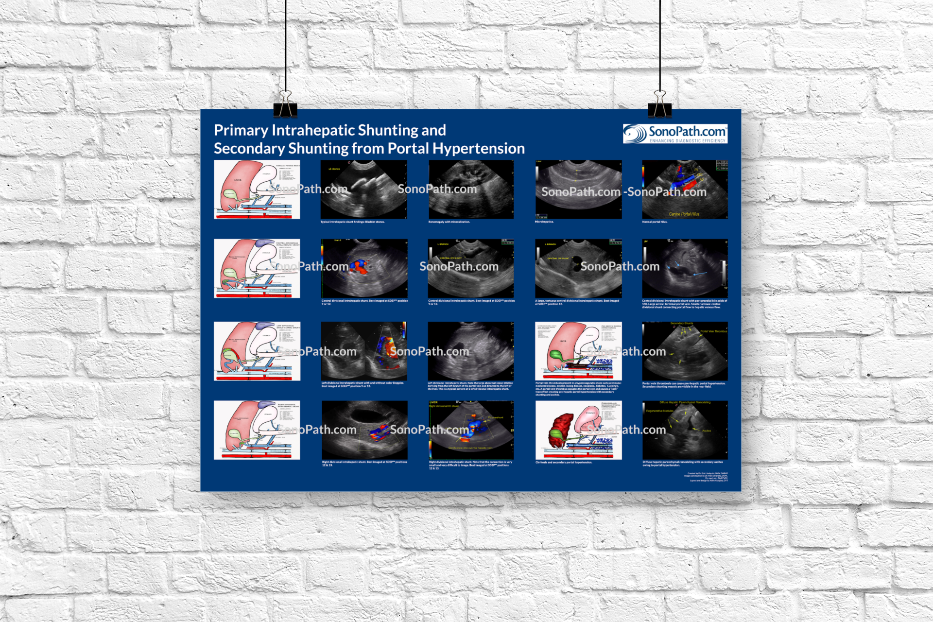 Primary Intrahepatic Shunting Poster