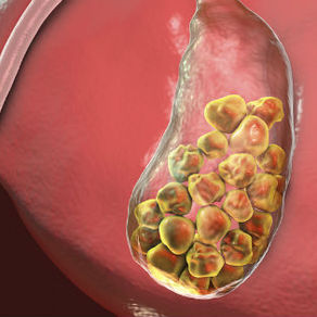 Cálculos biliares y su tratamiento