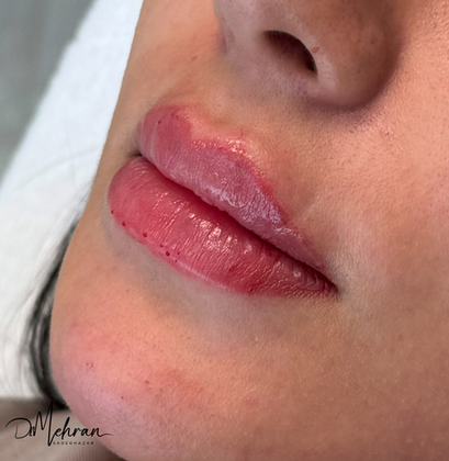 Cupid’s bow and lip border definition with lip filler in Dubai