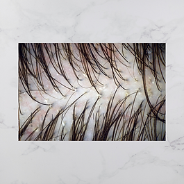 【対策】
1.刺激の少ないシャンプーに変更（アミノ酸系,ココイルグルタミン酸,ココイルメチルタウリンなど）
香料、アルコール、着色料が少ないもの◎
2洗い方を見直す（温度３６~38度、指の腹で優しく1分ほどマッサージすすぎは1分以上）
3乾燥ケア（保湿ローション、お風呂上りにすぐ数滴
4紫外線対策(分け目に紫外線が当たると赤みが悪化、頭皮用でスプレー型の日焼け止めを使用
通気性のある帽子を使用
お悩みの方は、当サロン迄、ご相談くださいね
