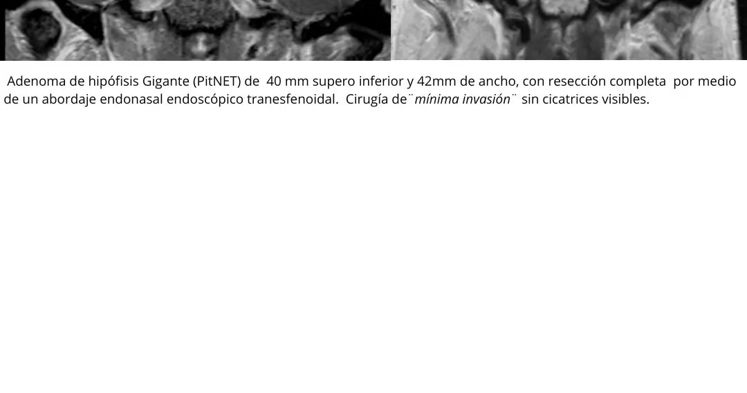 Comparación preoperatoria y posoperatoria de un adenoma de hipófisis tratado mediante cirugía endoscópica transesfenoidal.