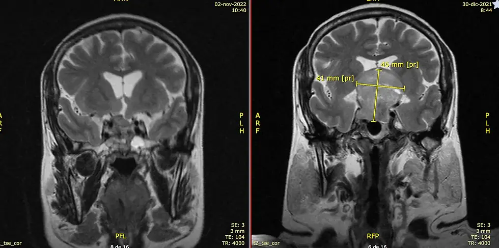 Adenoma Gigante ya operado, antes y después coronal