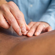 acupuncture