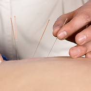 Acupuncture