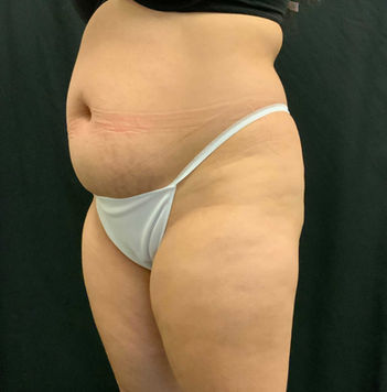 Liposuction 360 before and after photos