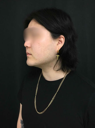 Male Chin Liposuction Before and After