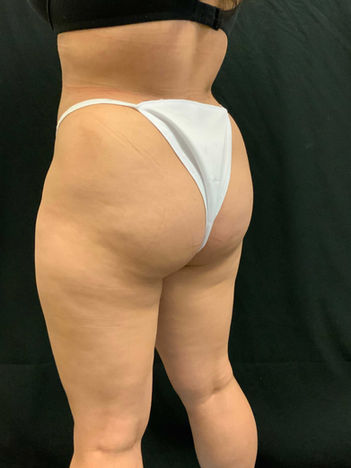 Liposuction 360 before and after photos
