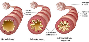 Asthma2.jpg