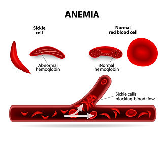 anemia-explainer.jpg
