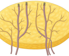 Optimizing Intraflap Anastomosis of Conjoined Bilateral DIEP Flaps for Breast Reconstruction
