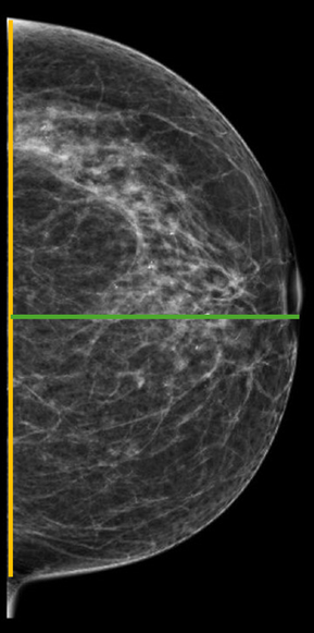 A Quantitative Evaluation of the Effects of Radiation Therapy on the Postsurgical Breast