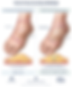 Subunit-Based Intraflap Debulking Technique for Secondary Contouring After Free Flap Reconstruction