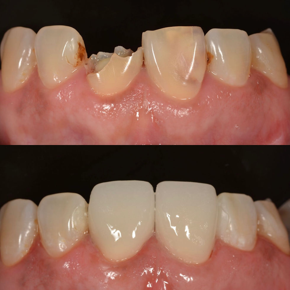 caso realizado en una sesión con CEREC