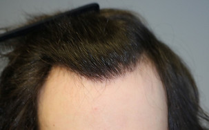 Photo after hair transplant with Dr. Panine at Chicago Hair Transplant Clinic