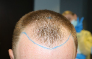 Hairline before hair transplant