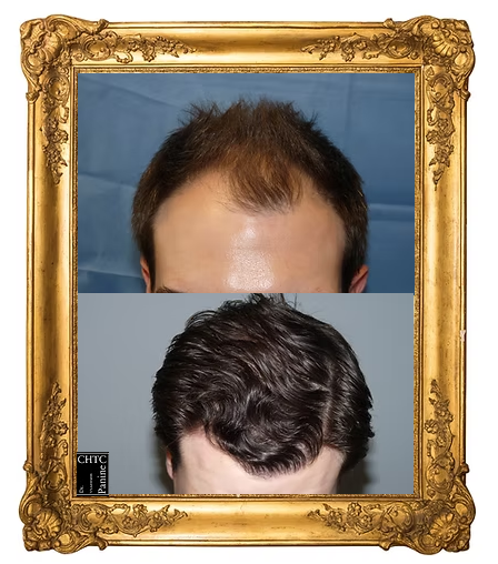 Hairline before and after hair transplant with Dr. Panine