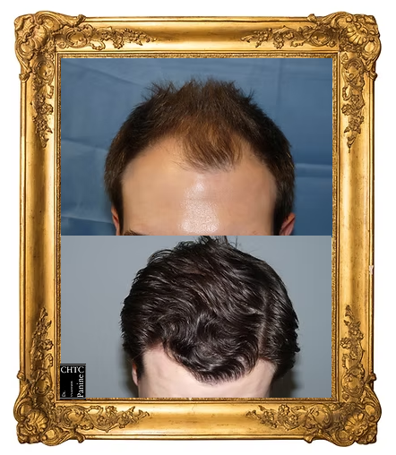 Hairline before and after hair transplant with Dr. Panine