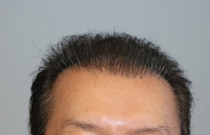 Results after hair transplant with Dr. Panine