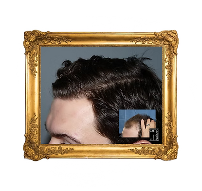 Before and After a FUE hair transplant mega session with Dr_edited.png