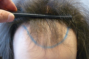 Before hair transplant