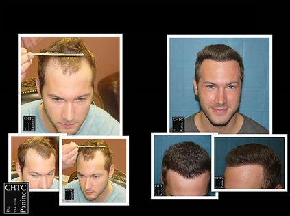 Results of Hair Transplant Correction