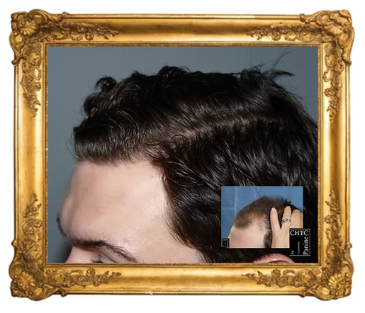 Before and After a FUE hair transplant mega session with Dr. Panine