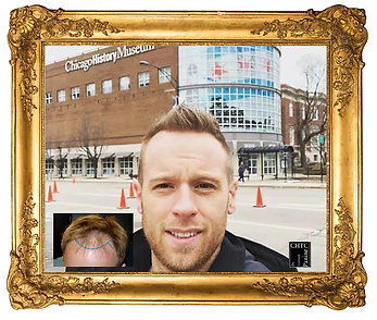 Results of an FUE Hair Transplant with Dr. Panine