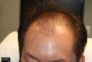 Photo before a hair transplant with Dr. Panine