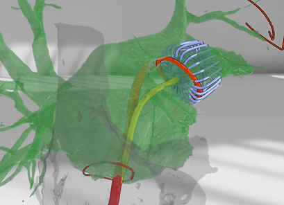 経皮的左心耳閉鎖のVRシミュレーション