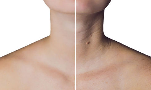 Neck-lift.jpeg