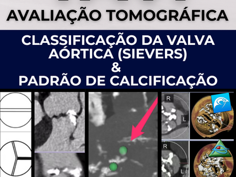 Avaliação tomográfica para TAVI: Classificação da valva aórtica e padrão de calcificação.