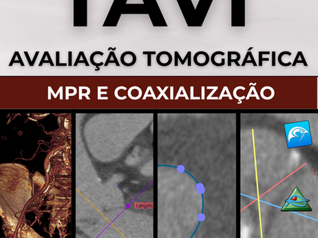 Avaliação tomográfica para TAVI: reconstrução multiplanar (MPR) e Coaxialização