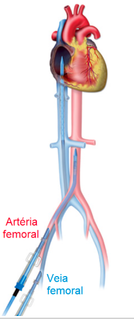 Canulação periférica femoral