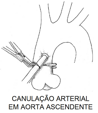 Canulação arterial na aorta