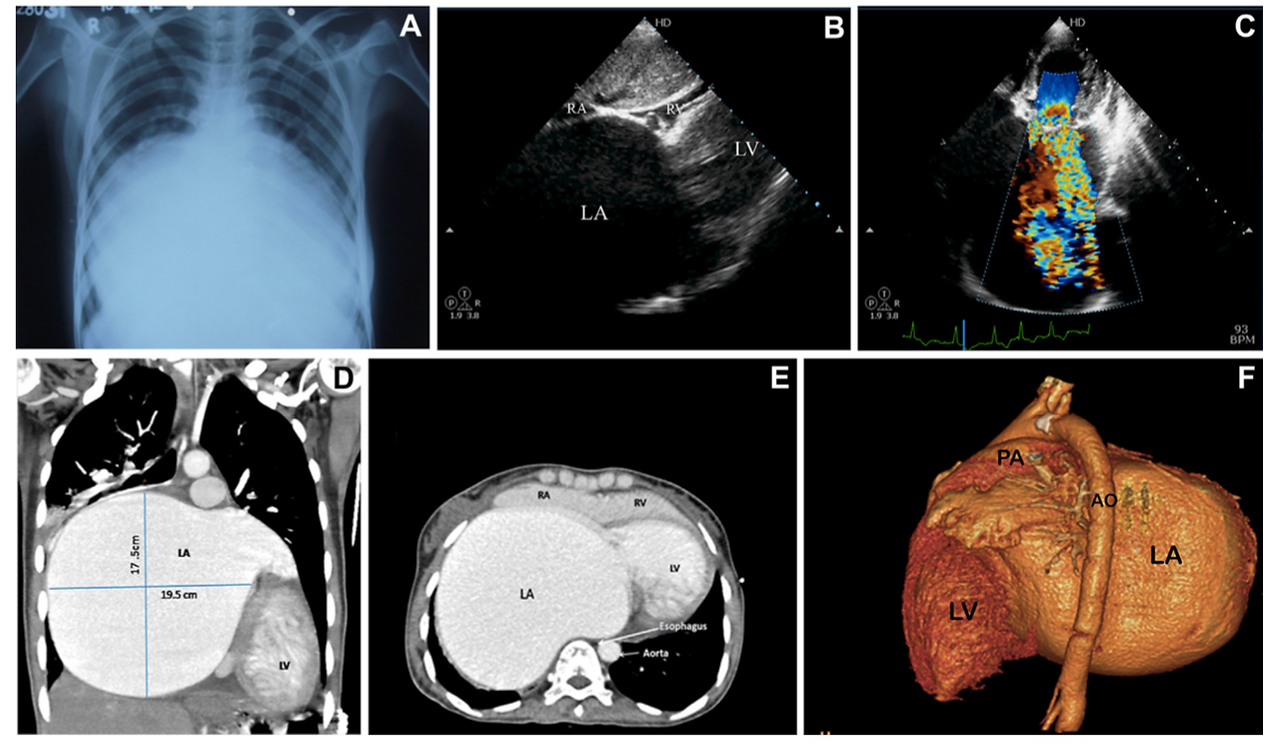 Giant Left Atrium Due to Rheumatic M