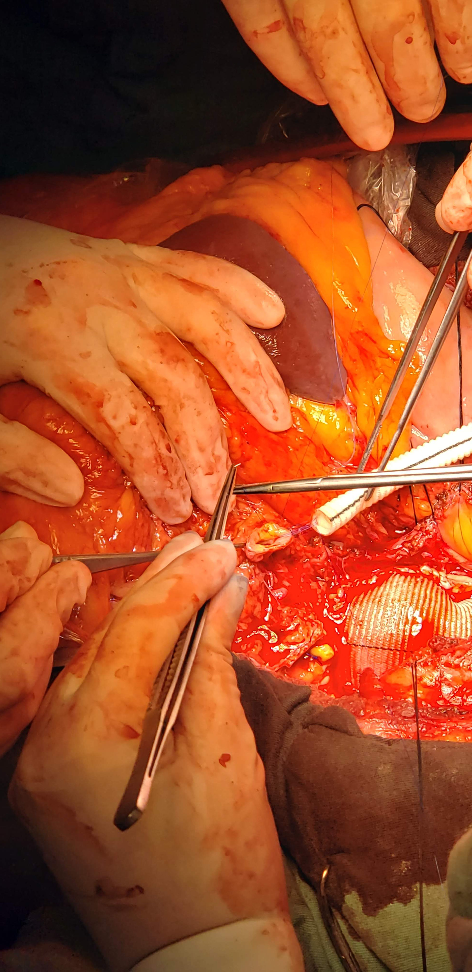 Anastomose da artéria renal direita