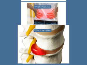 Herniated Disc Treatment in Naperville: Causes, Symptoms, and Pain Relief Options