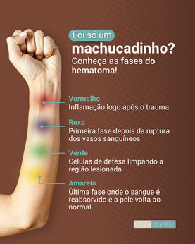 Foi só um machucadinho? Conheça as fases do hematoma!