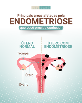 Principais áreas afetadas pela endometriose que você precisa conhecer