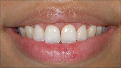Crown Lengthening After.jpeg