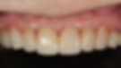 implant case1 after