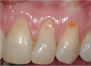 Graft Case1 Before.jpeg