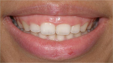 Crown Lengthening Before.jpeg