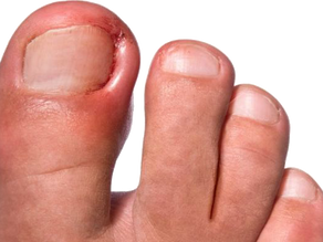 ONICOCRIPTOSIS (uña incarnada)