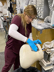 Hip Disarticulation; second socket is being fabricated.