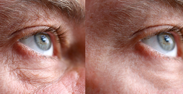 Closeup 45-50 years old shows the before and after results of successful blepharoplasty su