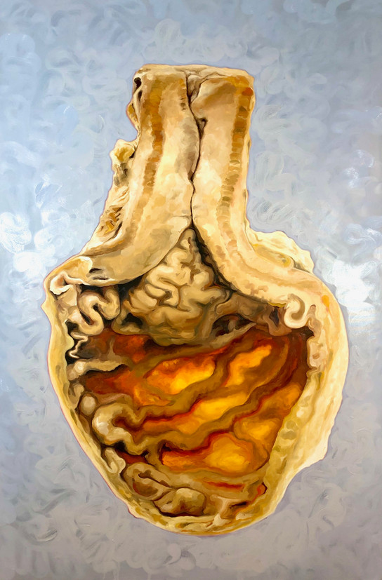 Stomach Preservation (Pathological Sample of Esopheogeal Tumor, 1950)